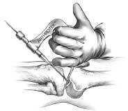 Prepare the Achilles Allograft The surgeon or an assistant can prepare the Achilles tendon allograft.