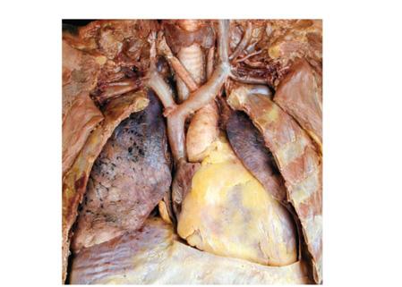 Epicardium visceral layer of the serous pericardium Myocardium consists of cardiac muscle