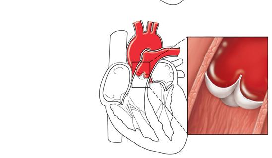 (b) AV s closed; atrial pressure less than ventricular pressure Atrium Cusps of atrioventricular