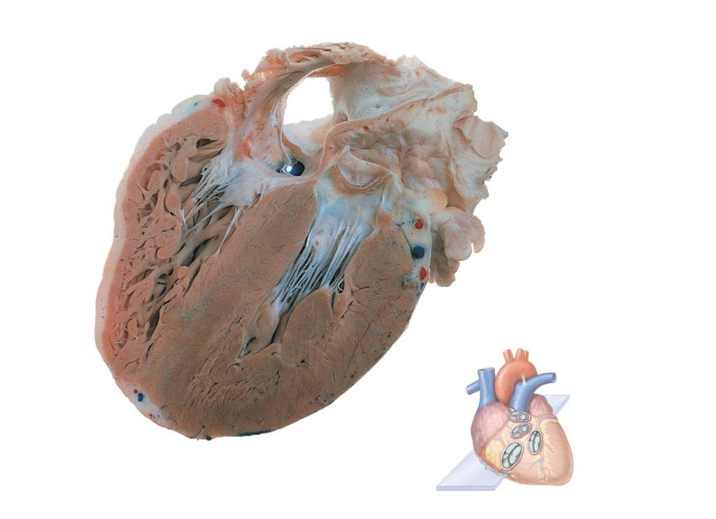 Opening of inferior vena cava Tricuspid valve Myocardium of right ventricle Mitral valve Chordae tendineae Myocardium of left