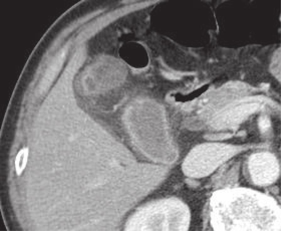 Sato et al. Surgical Case Reports (2016) 2:62 Page 2 of 5 Fig. 1 Computer tomography demonstrated a cystic mass protruding outward from the fundus of the gallbladder (white triangles).