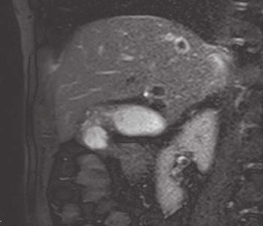 There was no stone nor anomaly in the extrahepatic bile duct, and high signal was not detected with diffusion-weighted image. Intramural nodule was not evident in any of the imaging studies performed.
