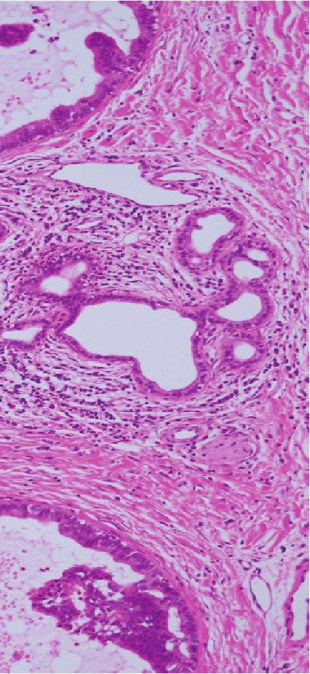 (d) Papillary carcinoma with columnar epithelia and fine