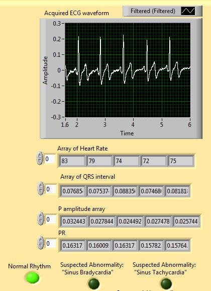 In this way the observed values for PR interval and QRS interval have been noted for other abnormalities like Bradycardia, Tachycardia