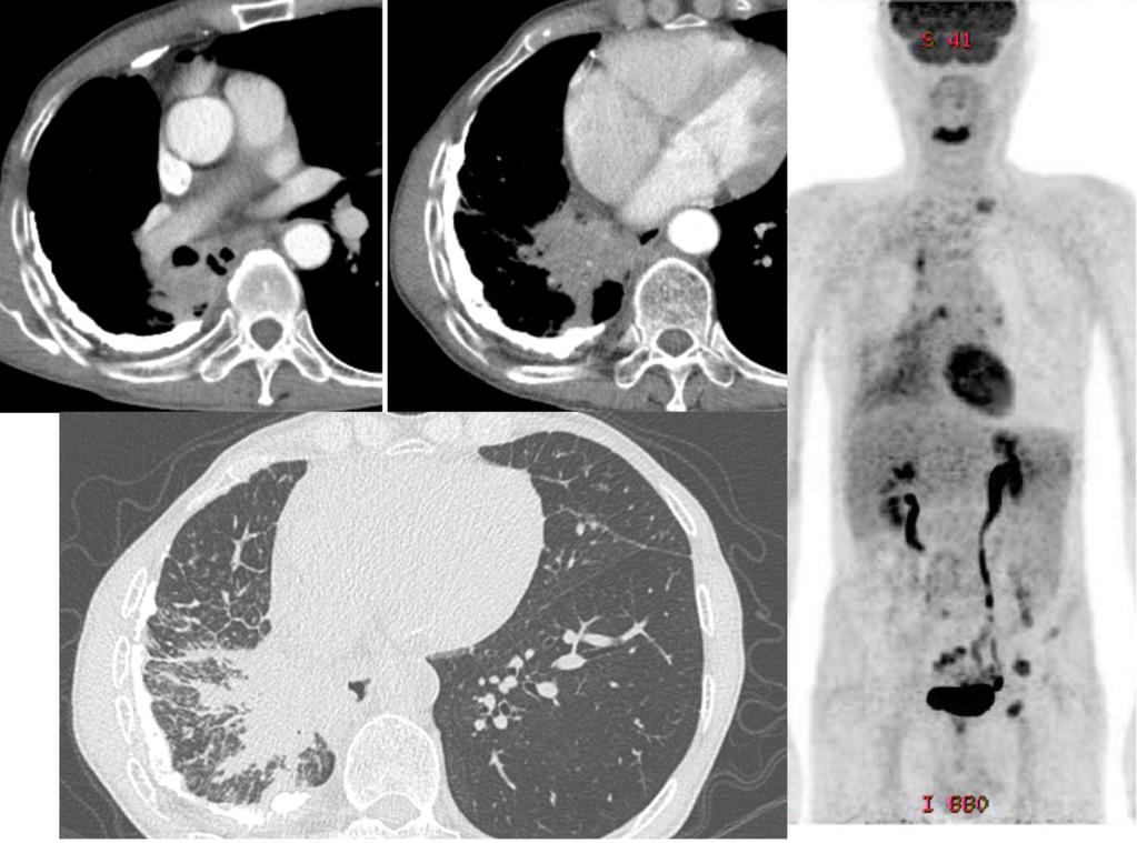 Fig. 1: The Patient 1. Enhanced CT images (the upper left two images) show the right lower lobe superior and right lower lobe basal consolidation. The right lower lobe superior bronchus is obstructed.