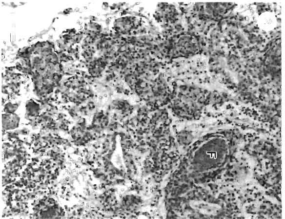 172 Dls Aquat Org 31 169179, 1997 Fig 2. Penaeus rnonodon infected with GAV. Lymphoid organ, show~ng defined, darkly eosinophilic foci of necrotic cells (F). H&E.