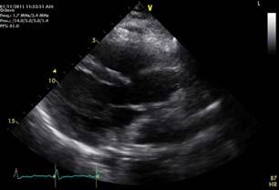 Cardiac Transplantation-Rejection Role of echo Cardiac Biopsy- Gold