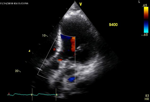 Evaluation of Aortic Insufficiency AI may be present in systole and diastole Likely to progress over time Increases PCW and PA pressure with greater RV afterload Moderate or severe AI may warrant