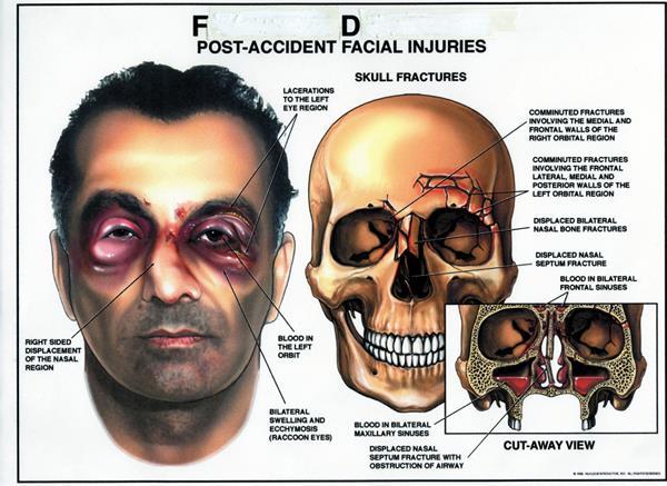 Clinical Relevance: Nasal Fracture Due to the Prominence of the external nasal skeleton, nasal fractures are common- the most common facial fracture.