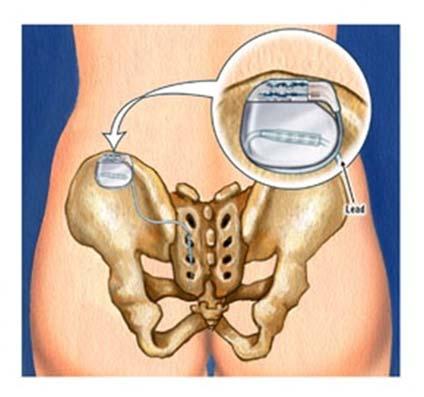 Sacral Neuromodulation Minimally invasive procedure FDA approved in 1997 Two stage procedure 1-2 week test stage Implant stage Implantation of the Sacral Neuromodulation System Procedure done in
