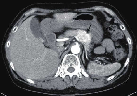 275 Choline-positive and FDG-negative RCC Fig. 1: Arterial phase image of contrast-enhanced dynamic CT shows a well-defined, 35 40 mm, mass with strong enhancement on the pancreatic body (arrow).