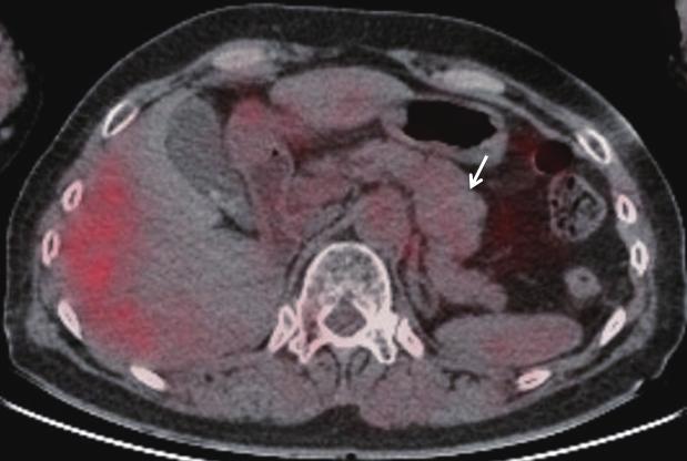 F-FDG PET/CT image shows no accumulation Fig. 2: in the pancreatic body mass (arrow). Fig. 4: Microsopic examination of the tumor demonstrated metastatic clear cell carcinoma.