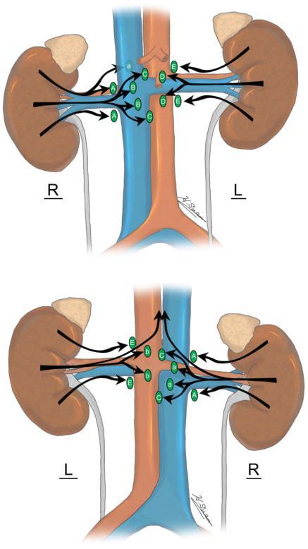 Summary of Renal Lymphatic Drainage Right Kidney Left Kidney Anterior Efferent Lymphatic Vessels A. Paracaval B. Precaval C. Interaortocaval a. Retrocaval D. Preaortic E.