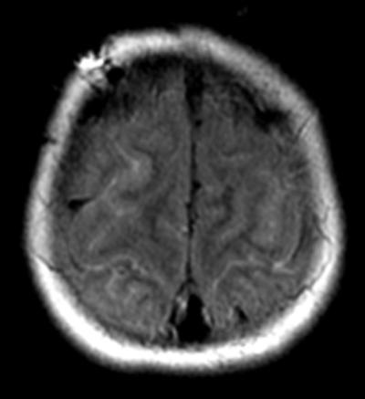 Meningitis: MRI Imaging Findings: FLAIR: high signal in subarachnoid space due to elevated protein May see arterial narrowing due to infectious arteritis with or without infarction
