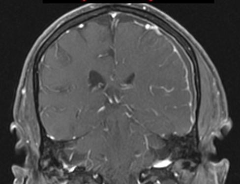 Subdural empyema: CT: Isodense collection Subdural empyema, DDX: Chronic Subdural hematoma Subdural effusion (sterile CSF collection associated with meningitis) Subdural hygroma Dural based