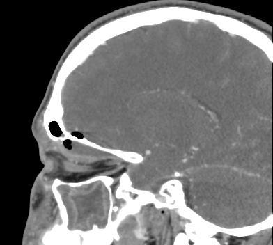 Epidural abscess Usually associated with head and neck infection: Sinusitis Otomastoiditis Post trauma