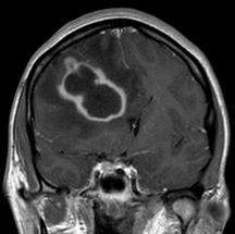 Pyogenic abscess Parenchymal mass Gray-white junction Low T2 ring Hyperintense necrotic core Rim enhancement Thick