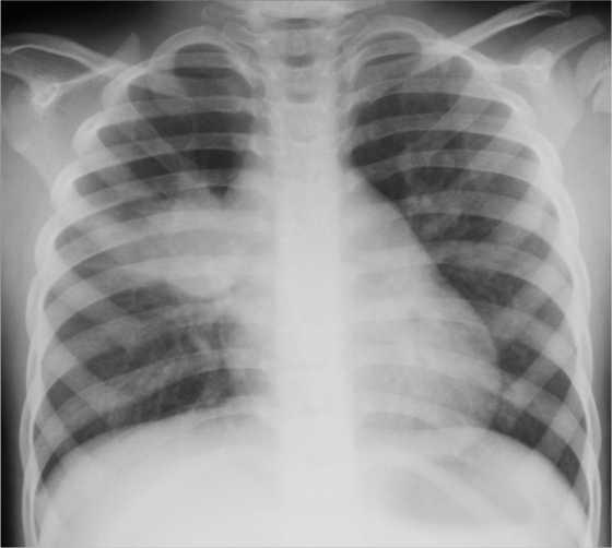 Chest X-Ray pictures