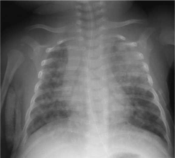 Infants can present as severe pneumonia with extensive parenchymal disease and respiratory