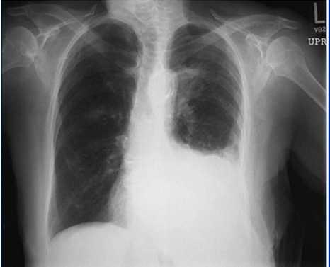 Tuberculous Pleural Effusion Pleuritic chest pain; dypnoea Pleural fluid analysis: High