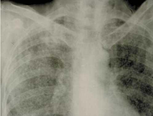 Miliary Tuberculosis Haematogenous spread of TB Presents as pyrexia of