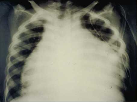 Tuberculous Pericarditis Tachycardia, tachypnea, leg edema, congested neck veins, distant heart sounds,