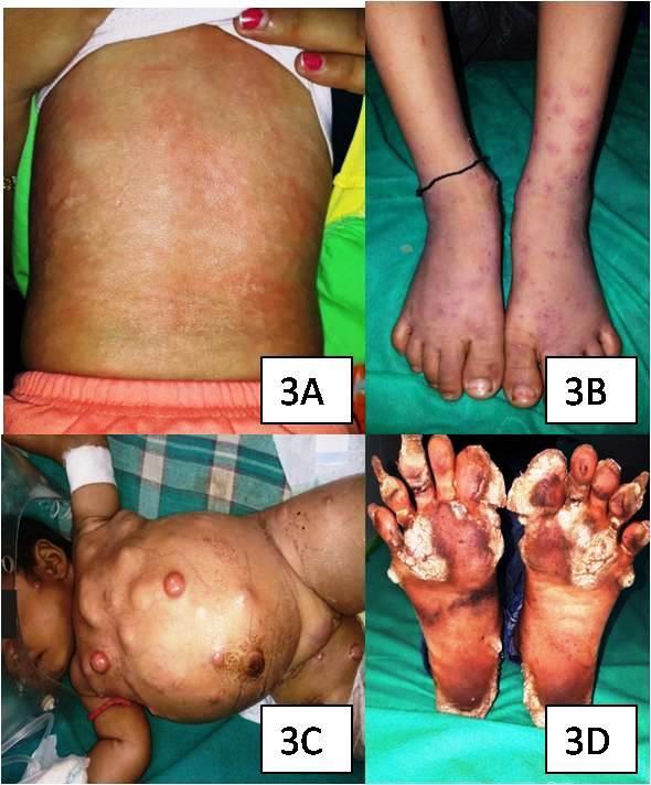3A) There were two cases of drug reactions, one was of Steven Johnson s syndrome, a known case of focal seizures on carbamazepine and the other was of fixed drug reaction, a known case of diarrhea on