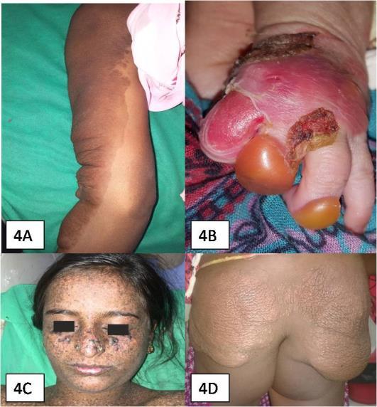 1 month old male patient of neuroblastoma presented with multiple erythematous nodules all over body and abdominal and pelvic mass on USG. (Fig.
