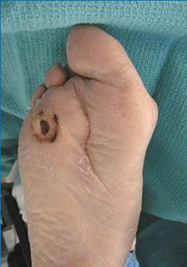 Resection for Diabetic Foot Ulcers Griffiths et al, Arch Surg 1990;