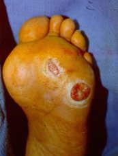 Metatarsal Head Resection for Diabetic Foot Ulcers Griffiths et al, Arch Surg 1990; 125; 832-835 Mean time of ulceration pre-op = 9.0 months Mean f/u 13.
