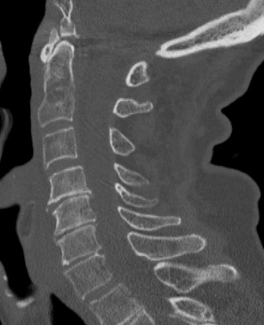Radiographic Findings CT requires fair amount of bony involvement to