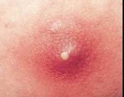 Source of Infection Hematogenous Skin infection» Furuncle(boil) found in only 15% Parenteral injections» IVDU Bacterial endocarditis UTI Resp infection Pharyngeal/Dental abscess Post Procedure