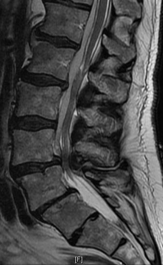 Case #4 80-year-old gentleman fevers and back pain no lower
