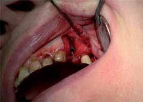 is used as a filler in odontostomatology
