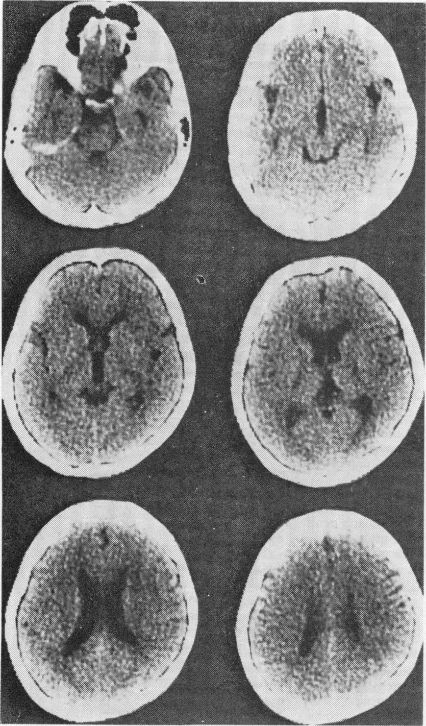 Fig. 2 CT scan of a 2-year-old youth with Duchenne dystrophy. There was slight enlargement of the interhemispheric fissure and both Sylvian fissures; the cerebral convexity sulci wer-e also apparent.
