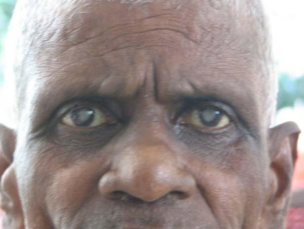 on 29/03/15) Patient with cataract in both