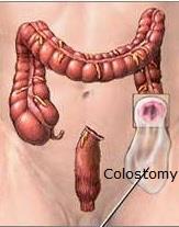 Crohn s Disease: - Colon disease: -