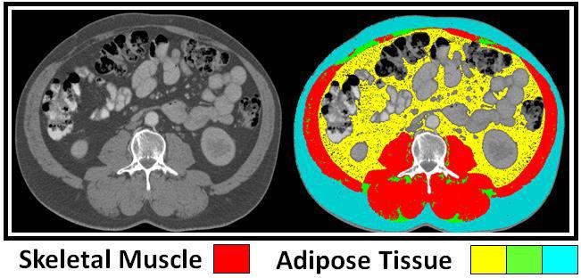 Full body CT and MRI scans can be analyzed using specialized software to quantify whole body muscle mass and adipose tissues. The cross-sectional area (CSA) of muscle or adipose tissue is Figure 3.