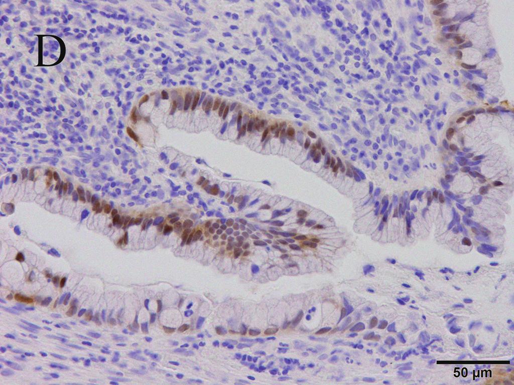 C: Mucinous adenocarcinoma showing both cytoplasmic and nuclear staining for maspin.