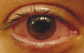 Pan uveitis: This affects all the three parts of uvea or the entire uvea. Q: What is acute and chronic, which the doctor tells me?
