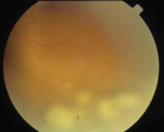 Posterior uveitis Fig 3. Intermediate Uveitis Posterior uveitis affects the back of the eye (the choroid) where your blood vessels supply the retina.