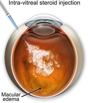 a. Steroid eyedrops help decrease the inflammation of the iris. They will be used frequently at first and then tapered off, to prevent the uveitis recurring. b. Steroid eyedrops may not used if a virus or bacteria caused the condition.