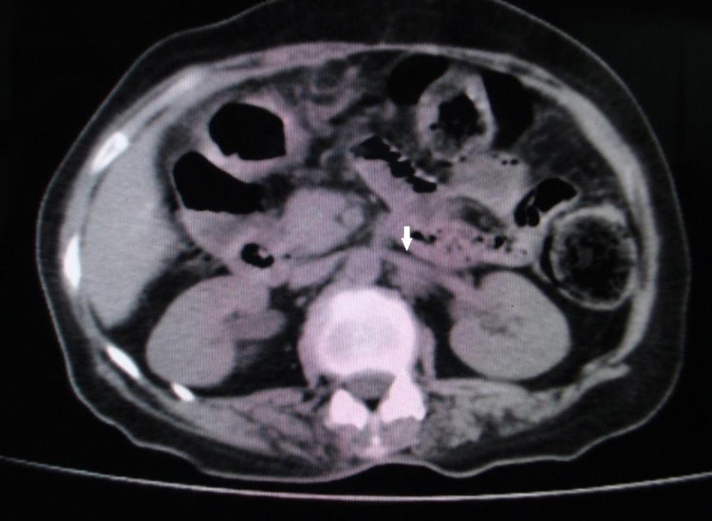 Multidetector Computed Tomography (MDCT) Axial Section of Abdomen At The Level Of Kidneys Showing Left Renal Vein Embryogenesis of Left Renal Veins And Its Communications Embryogenesis Between 6-8