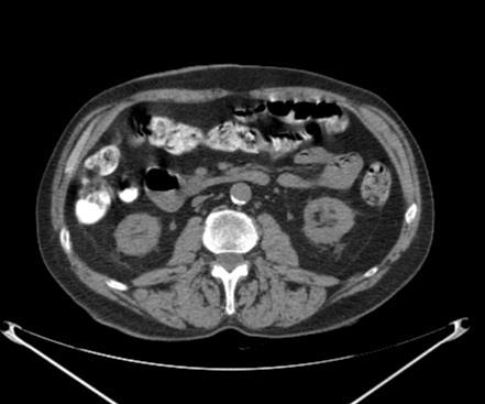 213) Kidney Ureter Lymph Lymph Node Node Kidney Patient with IHC+ bladder cancer