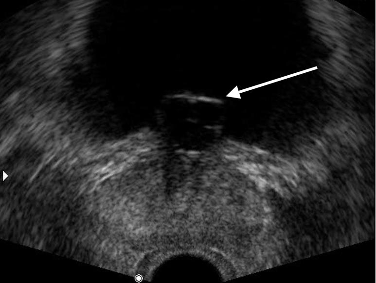 126 JY Lee, et al. Figure 1. Transrectal ultrasound showing the midline prostatic cyst located anteriorly. Figure 2.