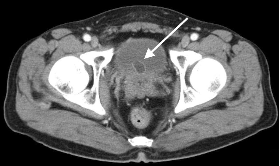 CT scanning suggested the presence of a urethrocele or a cyst of prostate origin, such as a Müllerian duct cyst (Figure 2). Other solid organs were all within normal limits on the CT scan.