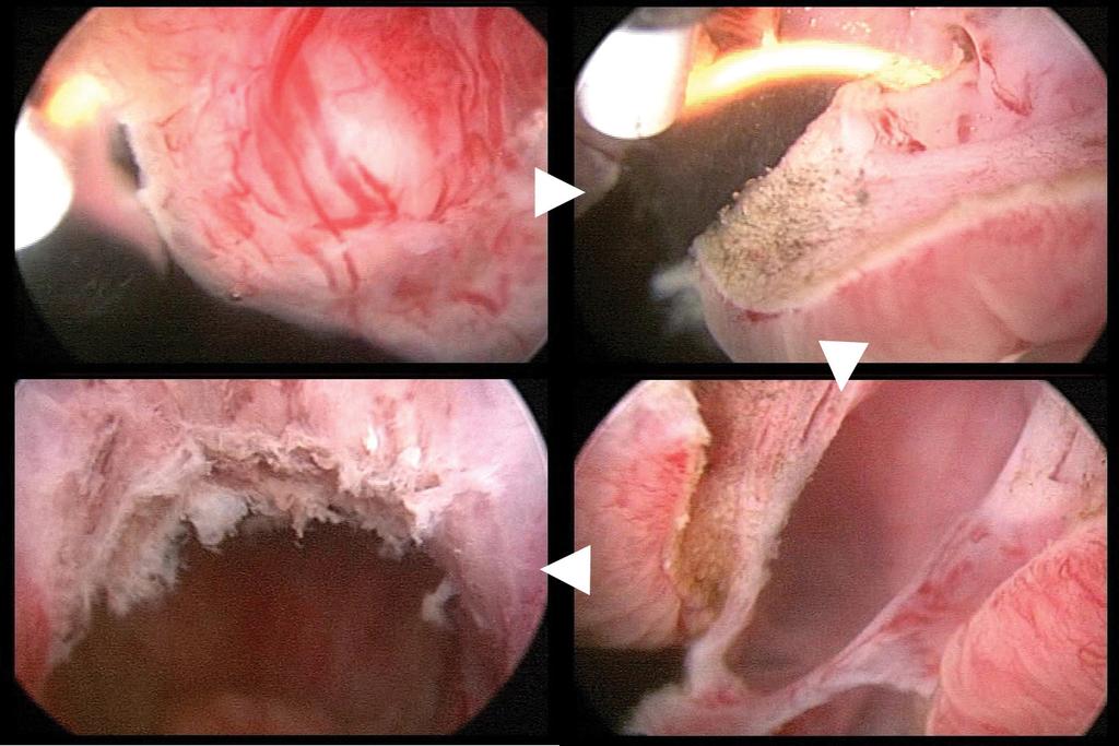 , Japan) and the forth picture shows the bladder neck after resection. the second postoperative day, and the patient was discharged on the third postoperative day.