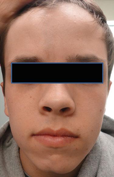 2 Localized Scleroderma 15 Fig. 2.12 Linear morphea of the forehead, nose, and chin (en coup de sabre) in a child.