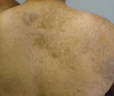 14 Linear morphea of the upper back and shoulder in an adult patient with dyspigmentation, hair loss, and dermal atrophy with increased vascular prominence of the posterior shoulder consistent with