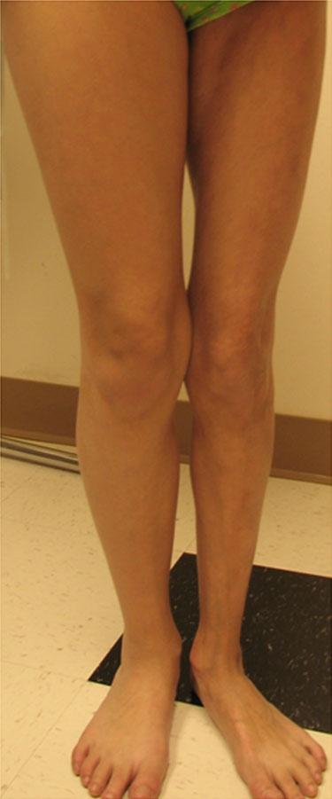 18 C.A. Bangert et al. Fig. 2.16 Child with linear morphea of the left lower extremity.